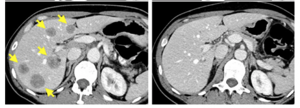 células-T-cáncer-mama-600x217 Cáncer de mama: Éxito al eliminar las células T de la propia paciente