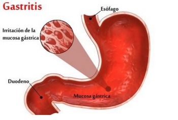 gastritis-2-350x236 Gastritis antral por Helicobacter Pylori, un dolor crónico