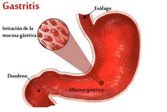 Que Es Bueno Para La Gastritis Cronica Antral