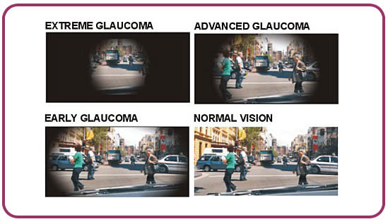 glaucoma_1 Cuando el Glaucoma no avisa