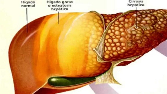 hígado-graso Cáncer de hígado: Hallazgo de nueva diana terapéutica