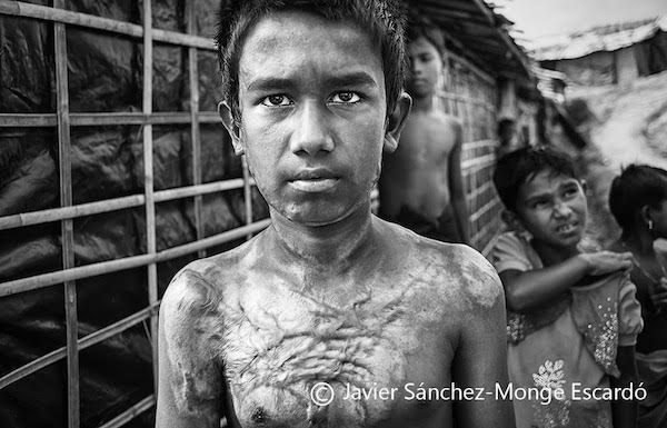 javier-sm-escardo-rohinyas8-refugiados-quemaduras-600x385 Amnistía: gigante japonés de la cerveza ha financiado la masacre de los rohingyas