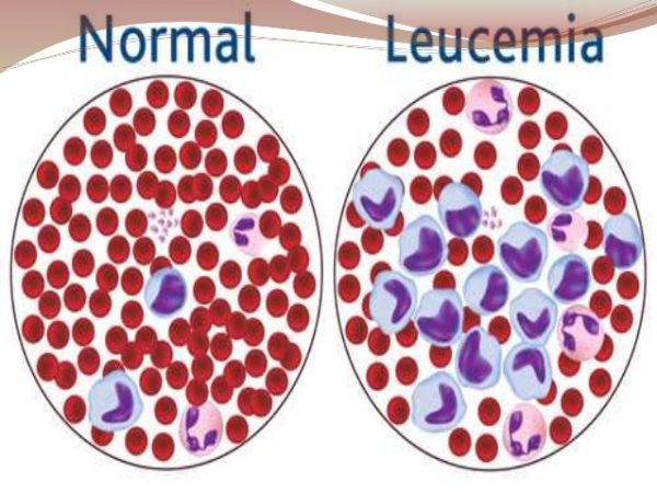 leucemia-6-638-600x450 Leucemia: Descifrado el epigenoma que la desencadena