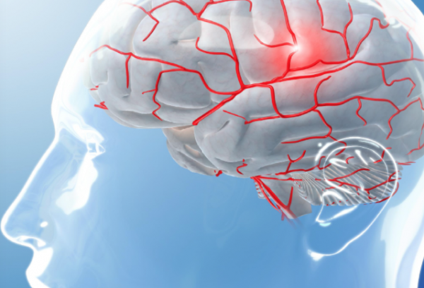 migrana-2-600x408 Migraña: descubren una mutación genética que provoca el aumento de la actividad neuronal