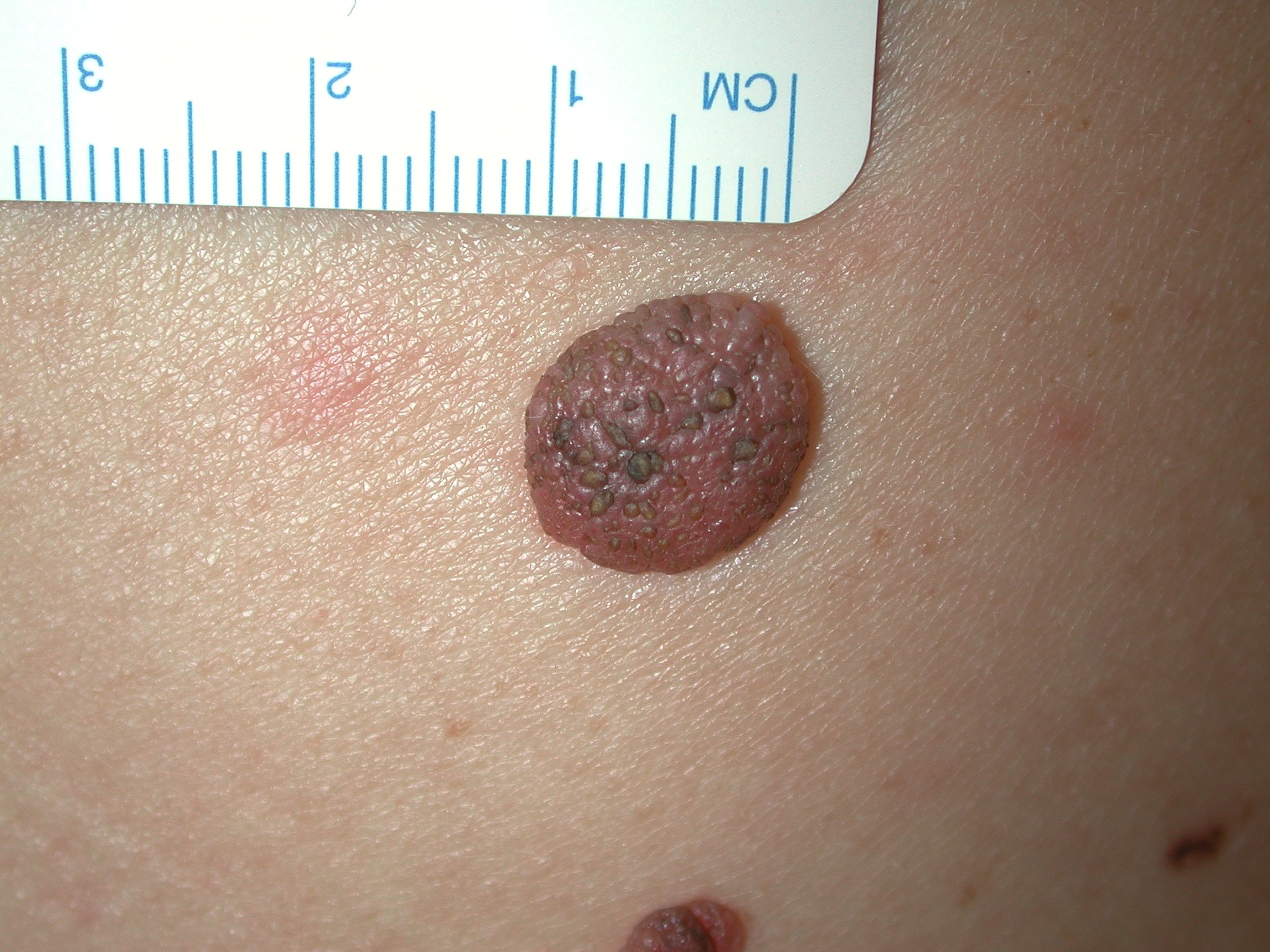 Melanoma de piel: cuando los lunares nos avisan | Periodistas en Español, image size:2048x1536