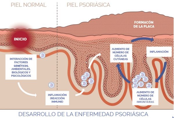 por_que_se_produce-1-600x405 Psoriasis: Muy cerca de la cura