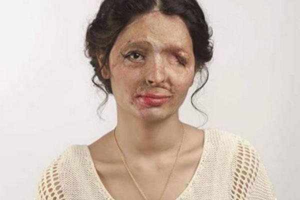 reshma-qureshi-acido-mujeres-india Reshma Qureshi, desfigurada por ácido, en la Semana de la Moda de Nueva York