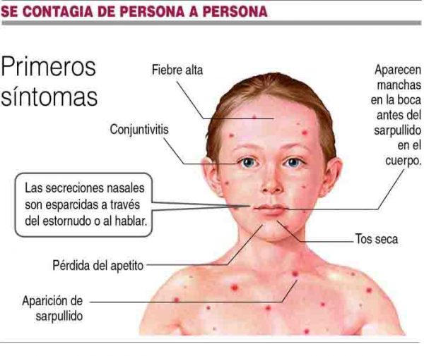 sarampión-contagio-600x505 Sarampión: un nuevo repunte que amenaza la salud