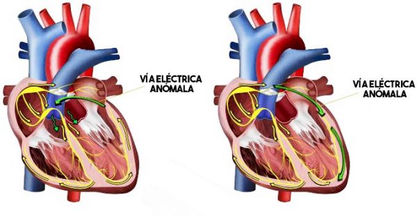 wolff-parkison-white-600x313 Síndrome de WPW: La ablación por radiofrecuencia como solución definitiva